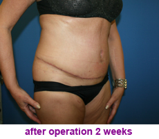 plastic-surgery-tummy-tuck